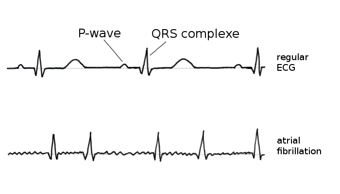 Atrial fibrillation